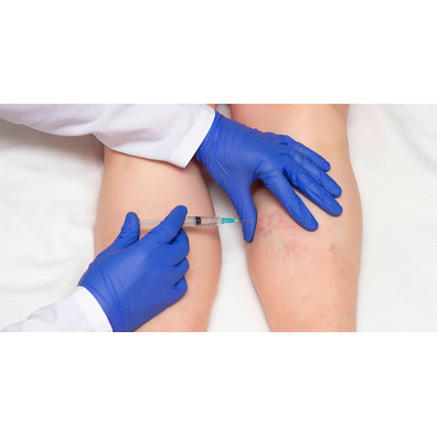 Tratamientos Medicina Estética - Escleroterapia Química