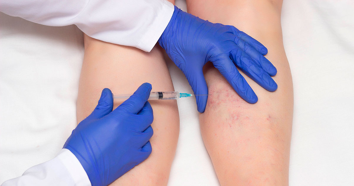 ESCLEROTERAPIA QUÍMICA